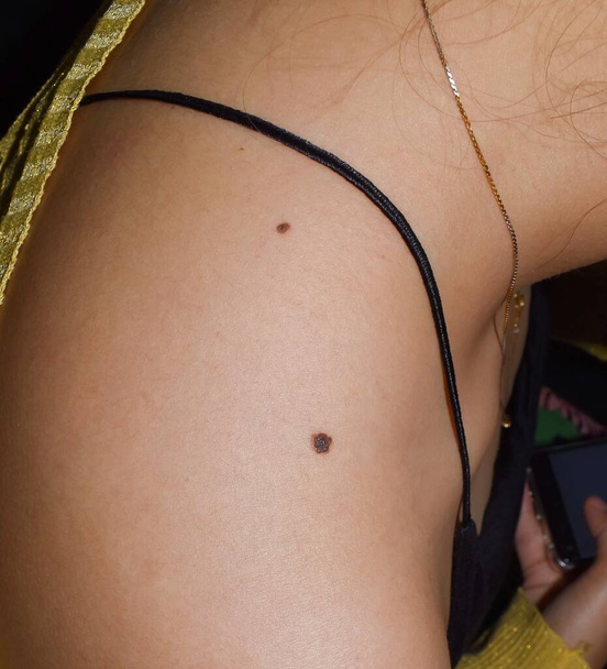 Junctional nevus ή διπλό τυφλοπόντικες στον ώμο της Νοτιοανατολικής Ασίας, Μιανμάρ νεαρή γυναίκα. Βρίσκεται στα όρια μεταξύ επιδερμίδας και δερματικών στρωμάτων του δέρματος. Αυτές οι κρεατοελιές μπορεί να είναι χρωματιστές και ελαφρώς ανυψωμένες. - Φωτογραφία, εικόνα