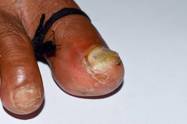 Celulitida na palci a atleti nohy nebo plísňové infekce mezi prsty na nohou jihovýchodní Asie muže. Detailní pohled. - Fotografie, Obrázek
