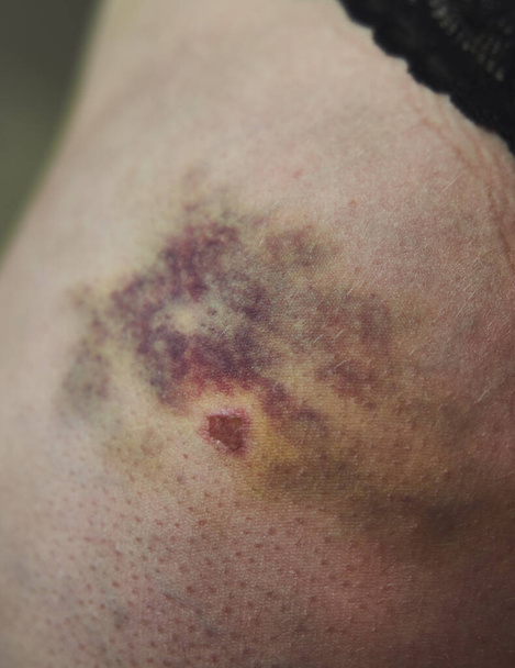 Trauma en la piel después de un accidente. Proceso de recuperación del hematoma. Sangrado interno después del impacto en la pierna - Foto, imagen