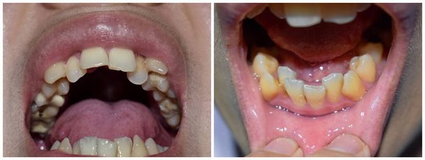 Asyalı bir adamın üst üste dizilmiş ya da üst üste dizilmiş dişleri. Ayrıca kalabalık diş de denir. Yakın görünüm. - Fotoğraf, Görsel