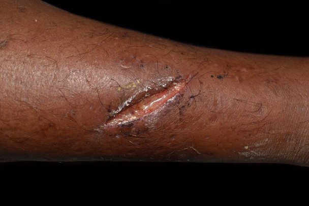 Pobre cicatrización de heridas o cicatrización secundaria con heridas grandes. Infección de heridas. Aislado en negro. - Foto, imagen
