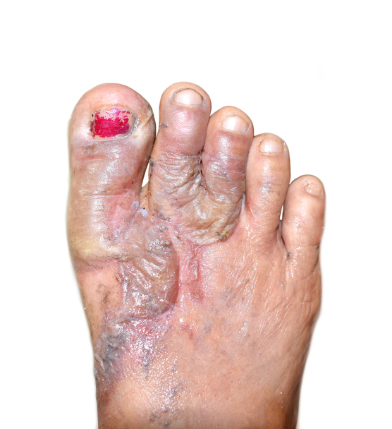 Herida quemada rodeada de costras y celulitis leve en los pies de la mujer del sudeste asiático. Aislado sobre blanco. - Foto, Imagen