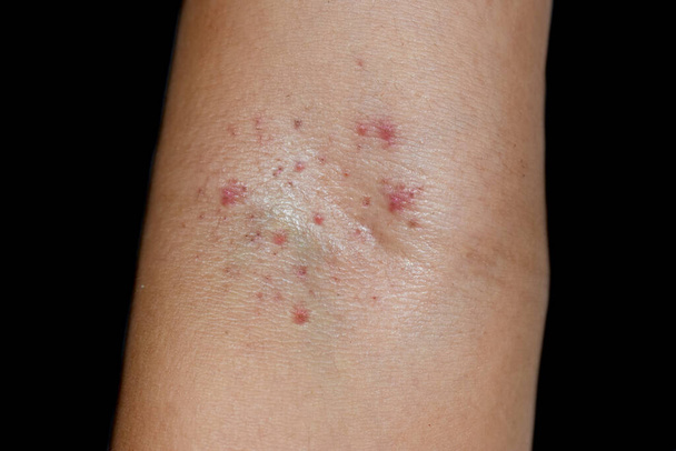 Skupina malých červených skvrn nebo petechií v krychlové fossa oblasti předloktí u asijského chlapce. Hess test nebo škrtidlo test je pozitivní a alespoň stupeň 1 dengue. Izolováno na černém pozadí - Fotografie, Obrázek