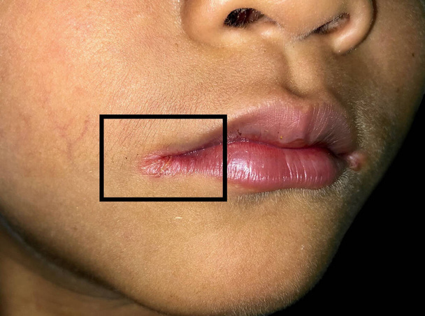 Kantige Stomatitis oder kantige Cheilitis oder Perleche bei einem kleinen asiatischen Jungen. Häufige entzündliche Erkrankung der Mundwinkel. Verursacht durch Eisen-, Zink- oder B12-Mangel oder wiederholtes Trauma. Isoliert auf schwarz - Foto, Bild