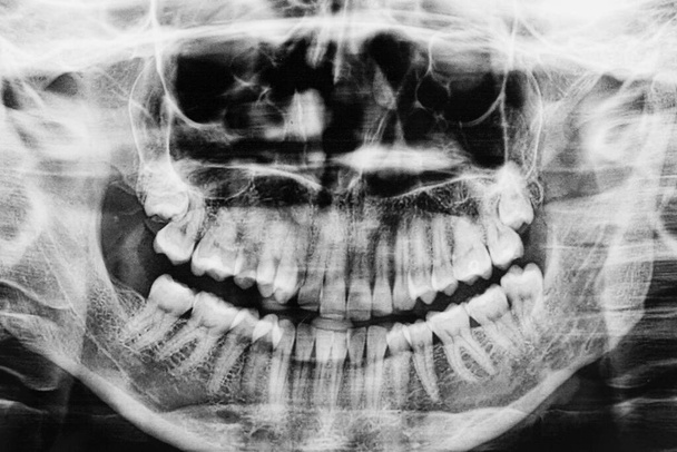 Different types of wisdom teeth problems concept. Teeth X-ray image scanned. Wisdom tooth crashed into a molar. Orthopantomography - Photo, Image