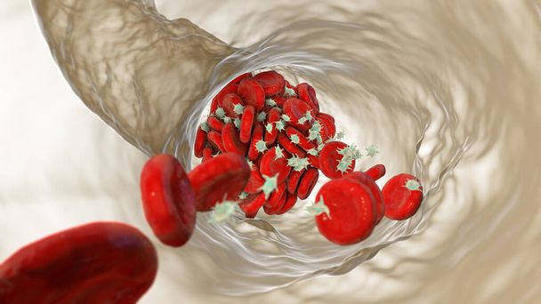 Caillot sanguin constitué de globules rouges, de plaquettes et de brins de protéines de fibrine. Thrombus, illustration 3D - Photo, image