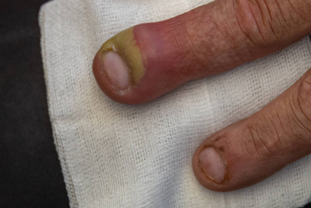 набряклий палець однієї руки внаслідок дерматологічної інфекції з заповненого гною нігтями та інфекційних бактерій концепції охорони здоров'я
 - Фото, зображення
