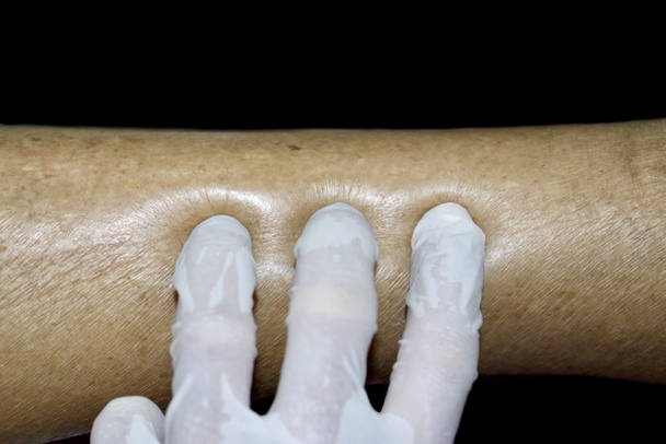 Pitting edema of lower limb. Swollen leg of Asian woman. Isolated on black. - Foto, imagen