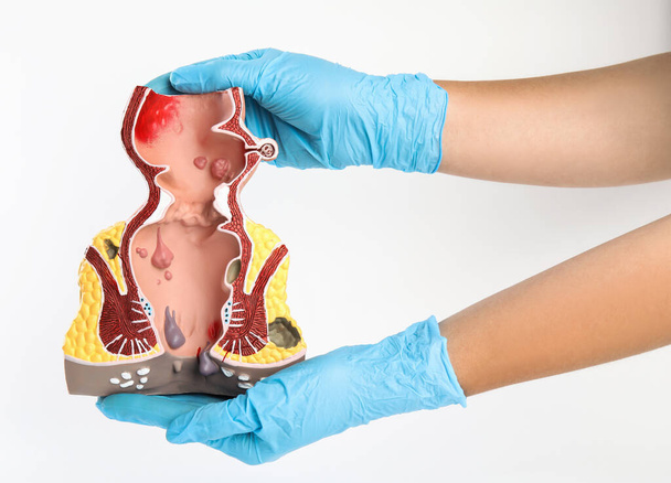 Proctologist holding anatomical model of rectum with hemorrhoids isolated on white, closeup - 写真・画像