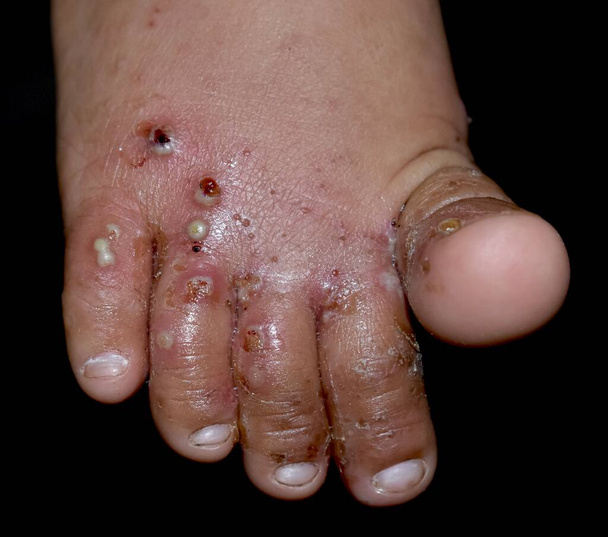 Infestación por sarna con infección bacteriana secundaria o superpuesta y pústulas en los pies del sudeste asiático, niño birmano. Afección contagiosa de la piel causada por ácaros. Aislado en negro. - Foto, imagen