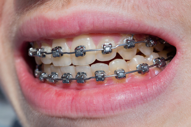 Mouth with bracket - Photo, Image