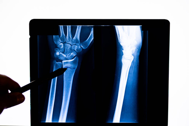 Az orvos ellenőrzi a röntgen felvételeket a beteg karjáról, ami sugár törésre utal. Röntgenkezű emberi kéz. A kézcsontok röntgenje. Orvosi technológia radiográfia. - Fotó, kép