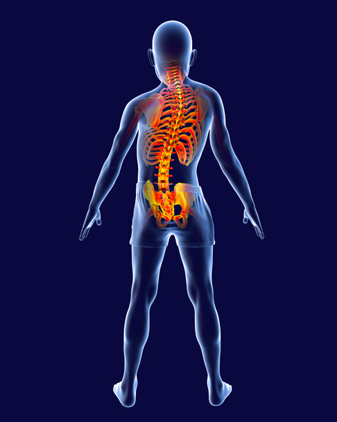 Scoliose, 3D illustratie. Een menselijk lichaam met gebogen ruggengraat, ongelijke schouders en heupen. Anatomie van de wervelkolom. Een kind met scoliose en gemarkeerd skelet, achteraanzicht - Foto, afbeelding