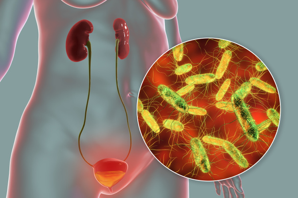 Kystiitti, virtsarakon bakteeri-infektio, käsitteellinen 3D-kuva bakteereista virtsassa - Valokuva, kuva