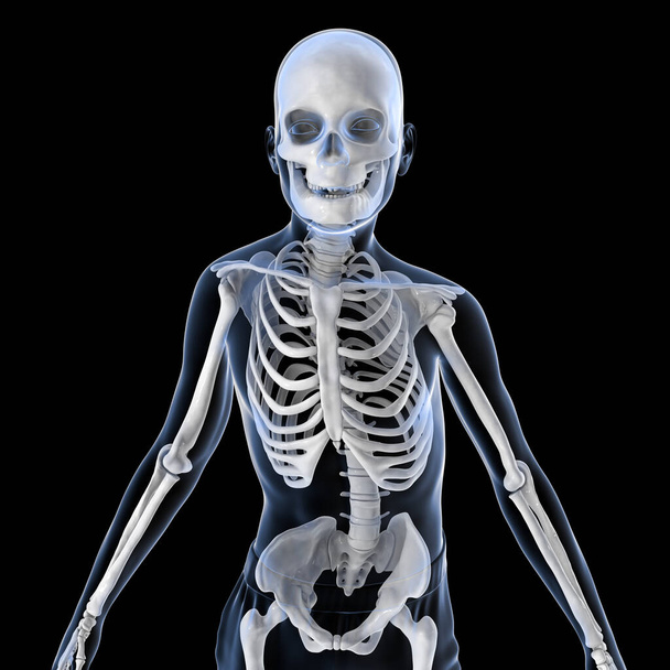 Сколиоз, 3D иллюстрация. Человеческое тело с изогнутым позвоночником, неровными плечами и бедрами. Анатомия позвоночника. Ребенок со сколиозом и выделенным скелетом, вид спереди - Фото, изображение
