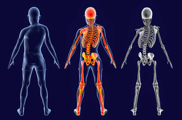 Skolioza, ilustracja 3D. Ludzkie ciało z zakrzywionym kręgosłupem, nierównymi ramionami i biodrami. Anatomia krzywej kręgosłupa. Dziecko ze skoliozą, z podkreślonym szkieletem i bez niego - Zdjęcie, obraz