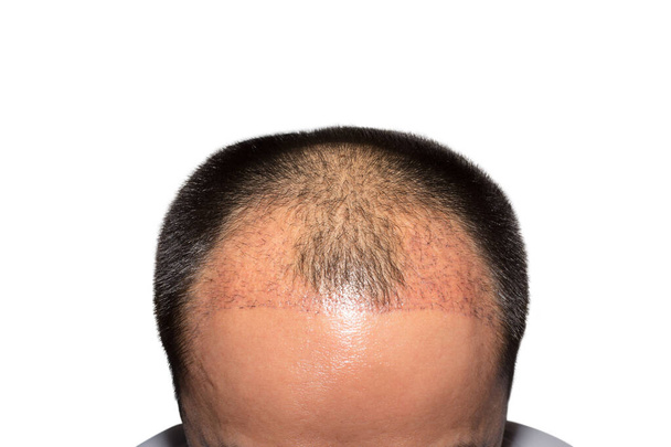 Закрыть верхний вид головы мужчины с помощью операции по пересадке волос с отступающей линией волос, изолированной на белом фоне - через 2 месяца после лечения выпадения волос. - Фото, изображение