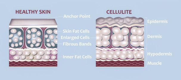 formación de celulitis bajo la piel ilustración - Foto, imagen