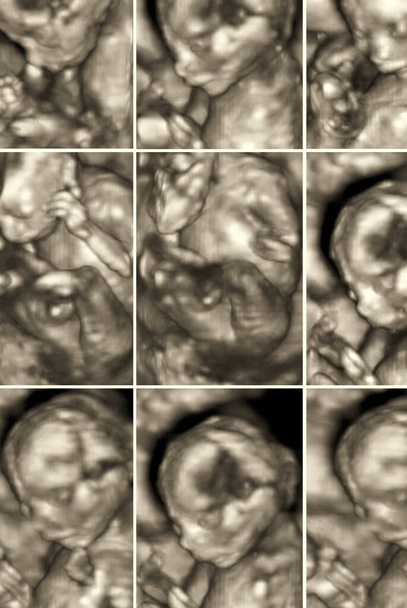 Pictures of 4D Ultrasound of baby in mother's womb. Collage of 3D Echography images. - Photo, Image