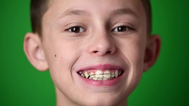 笑顔の赤ちゃん、男の子は歯を整列させるためのプレートを身に着けている、歯科ケア. - 映像、動画