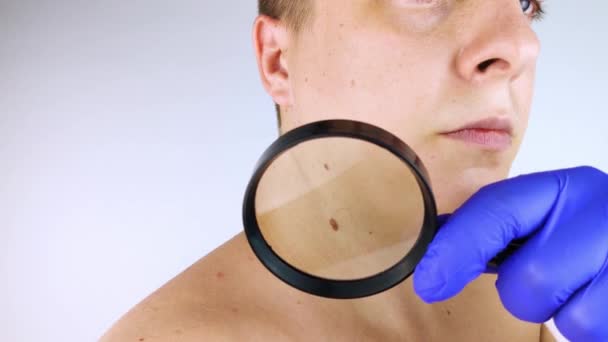 A man at a dermatologist appointment shows his birthmarks, moles and nevi. The doctor examines the patient with a dermatoscope. Benign and malignant birthmarks. Skin abnormalities care concept - Footage, Video