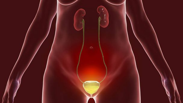 女性の過活動膀胱, 3Dイラスト.排尿する必要性の頻繁な感じがある状態,時には失禁を促すためにつながる膀胱制御の損失と, - 写真・画像