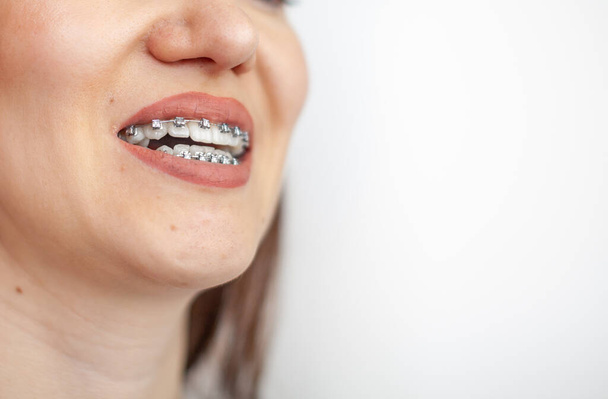白い歯にブレースをつけた少女の笑顔。歯がまっすぐになります。閉塞だ。歯科治療.  - 写真・画像