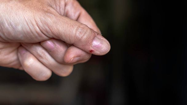 親指の怪我をした男性の手。爪の痛み。悪い習慣、かむと爪にハンガリーをリッピングします。手の治療、マニキュアの概念。コピースペース付き。選択的焦点 - 写真・画像