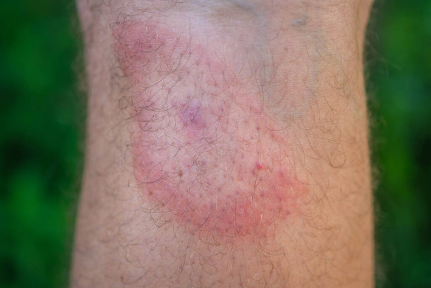 eritema migratorio después de una picadura de garrapata en la pierna de un hombre. un síntoma de borreliosis transmitida por garrapatas. un anillo rojo en forma de blanco en la pierna - Foto, Imagen