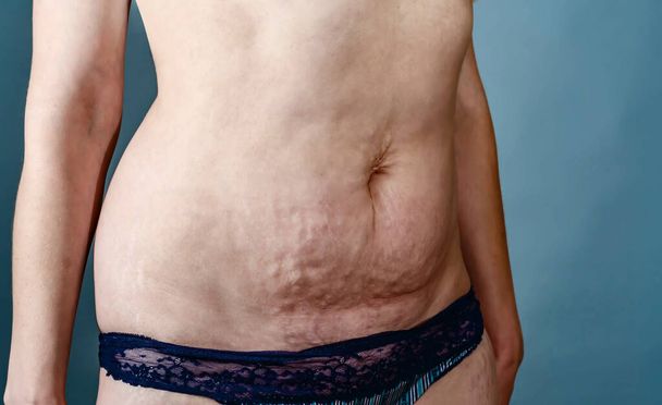 Belly of a woman with stretch marks on the skin after childbirth - Fotó, kép