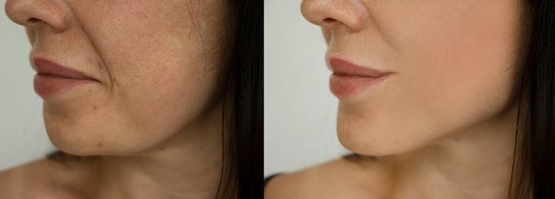 rugas da cara da mulher antes e após o tratamento - Foto, Imagem