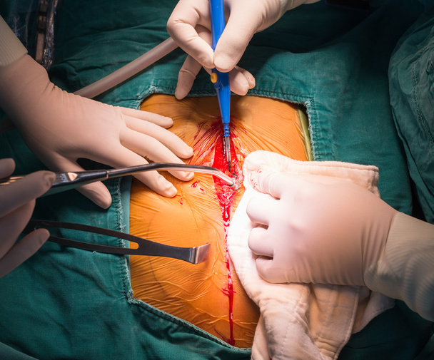 Mediana de la esternotomía incisión
 - Foto, imagen