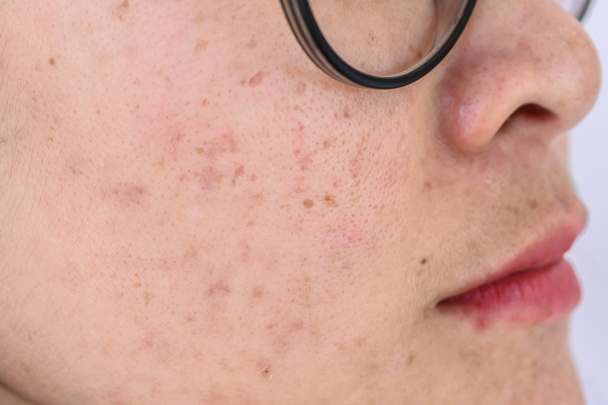 Close-up van het gezicht van de vrouw heeft verschillende problemen op haar huid (zoals acne, puistjes, poriën en melasma enz.). Conceptueel van natuurlijk probleem op de huid van de vrouw. - Foto, afbeelding