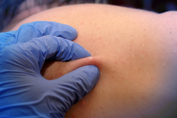 Um médico de luva examina uma acne nas costas. - Foto, Imagem