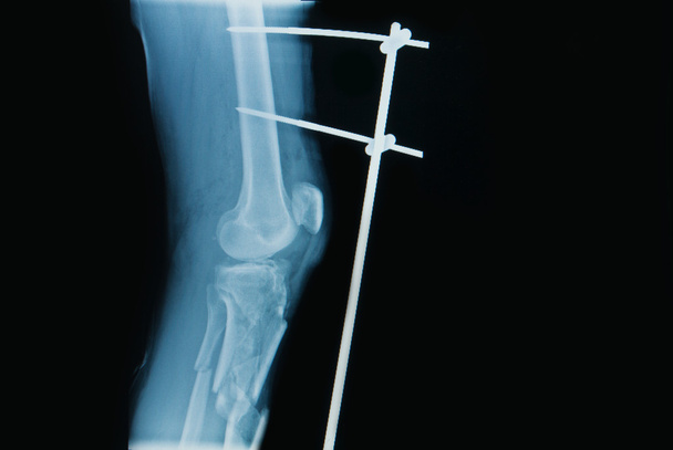 Röntgenbild einer Beinfraktur (Tibia) mit Implantat externem Fixat - Foto, Bild