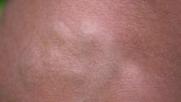Vene varicose possono essere visti sotto la pelle sulla gamba uomini macro. - Filmati, video