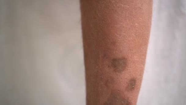 Pigmentované skvrny a vředy na noze osoby po operaci křečové žíly Nemoc lidské kůže. Noha na bílém pozadí. - Záběry, video