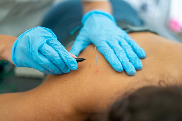 A closeup shot of a doctor connecting an acupuncture needle to the cable - Photo, Image