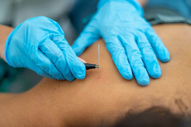 A closeup shot of a doctor connecting an acupuncture needle with the cable - Zdjęcie, obraz