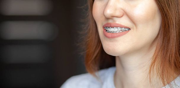 Das Lächeln eines jungen und schönen Mädchens mit Zahnspange auf ihren weißen Zähnen. Richten von schiefen Zähnen mit Hilfe eines Halterungssystems. Malokklusion. Zahnpflege. Glatte Zähne und ein schönes Lächeln - Foto, Bild