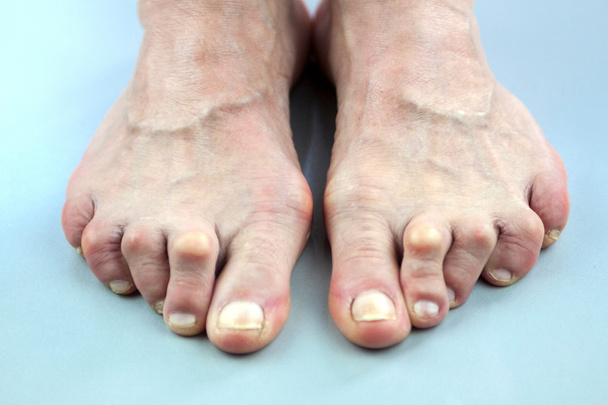 Romatoid artrit deforme kadın ayakları - Fotoğraf, Görsel