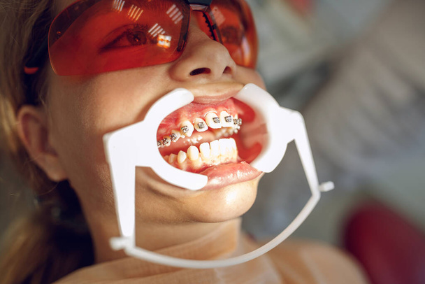 Nastolatka z aparatem na zębach odwiedzająca ortodontę w klinice. Instalacja systemu ortezy. - Zdjęcie, obraz