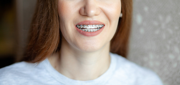 Das Lächeln eines jungen und schönen Mädchens mit Zahnspange auf ihren weißen Zähnen. Richten von schiefen Zähnen mit Hilfe eines Halterungssystems. Malokklusion. Zahnpflege. Glatte Zähne und ein schönes Lächeln - Foto, Bild