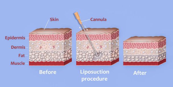 Mecanismo de liposucción. Liposucción asistida por succión. Tubo hueco o cánula, que se inserta a través de una pequeña incisión en la piel con el fin de eliminar la grasa del cuerpo - Foto, Imagen
