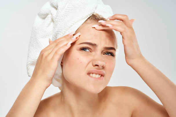 Nainen, jolla on pyyhe pään akne dermatologia tyytymättömyys iho-ongelmia - Valokuva, kuva