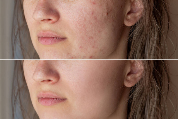 Cropped shot of a young woman's face before and after acne treatment on face. Pimples, red scars, rash on cheeks and chin. Allergies, dermatitis, bad nutrition. Problem skin, care and beauty concept - Photo, image