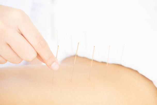 Gros plan de la main du médecin insérant l'aiguille d'acupuncture sur le dos du patient - Photo, image
