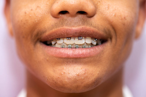 Close up shot of young boys brace laced teeth - Photo, Image