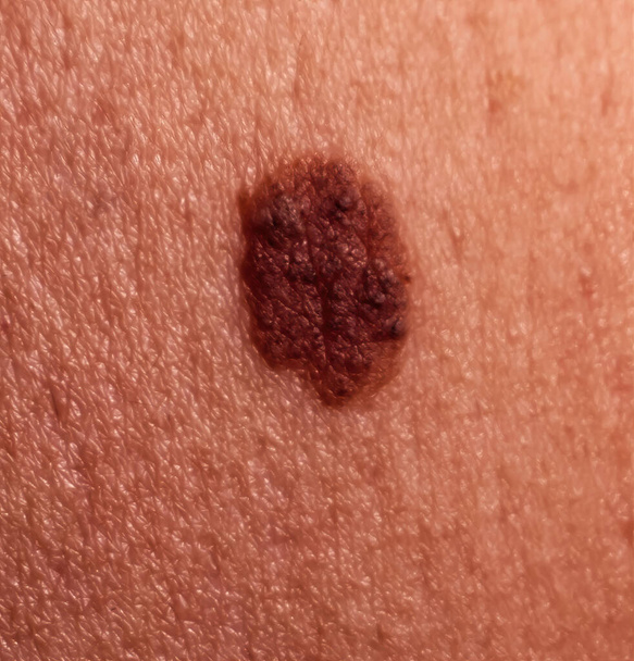 Large mole on human skin. Mole removal concept. Close-up, selective focus - Photo, Image