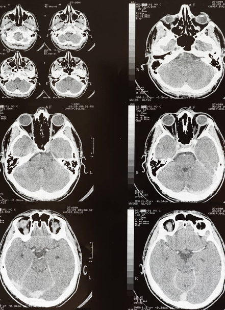 Imágenes por resonancia magnética (RM) del cerebro humano - sistema nervioso, examen - Foto, imagen